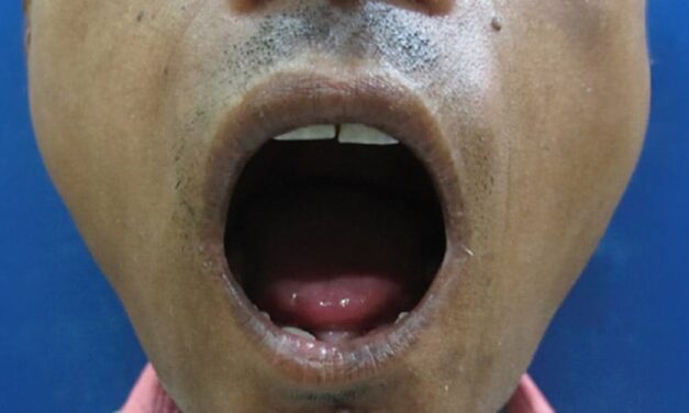 Managing Orofacial Changes in Scleroderma