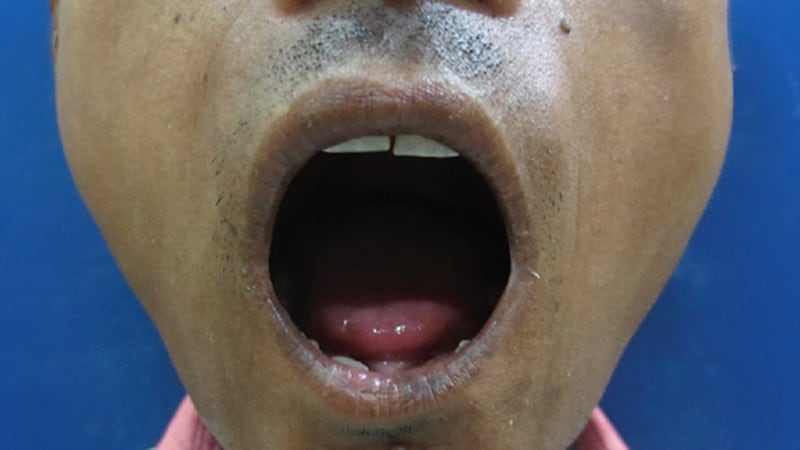 Managing Orofacial Changes in Scleroderma