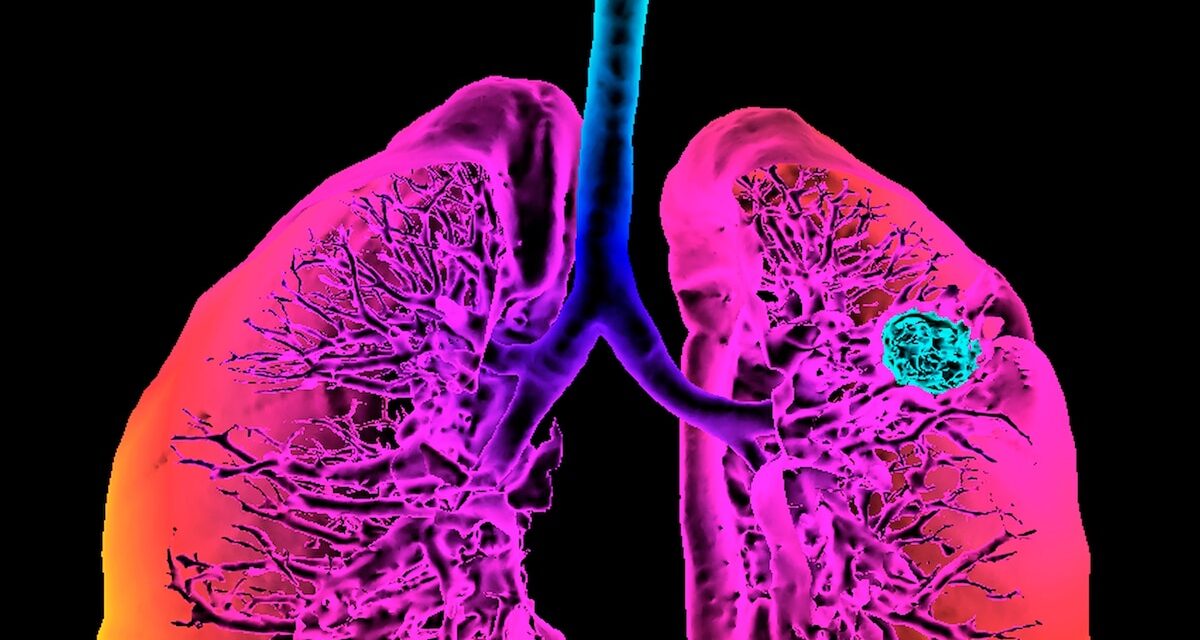 What we’re learning from lung cancer patients who never smoked