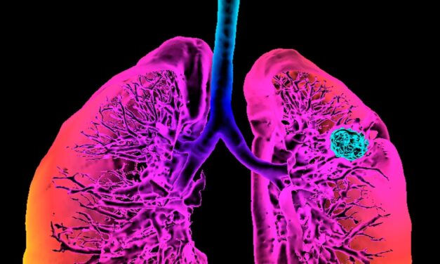 What we’re learning from lung cancer patients who never smoked