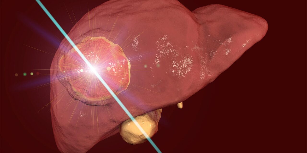 Favorable Outcomes With Microwave Ablation for Colorectal Liver Metastases